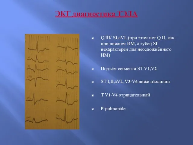 ЭКГ диагностика ТЭЛА Q III/ SI,aVL (при этом нет Q II, как