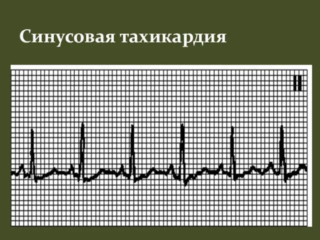 Синусовая тахикардия