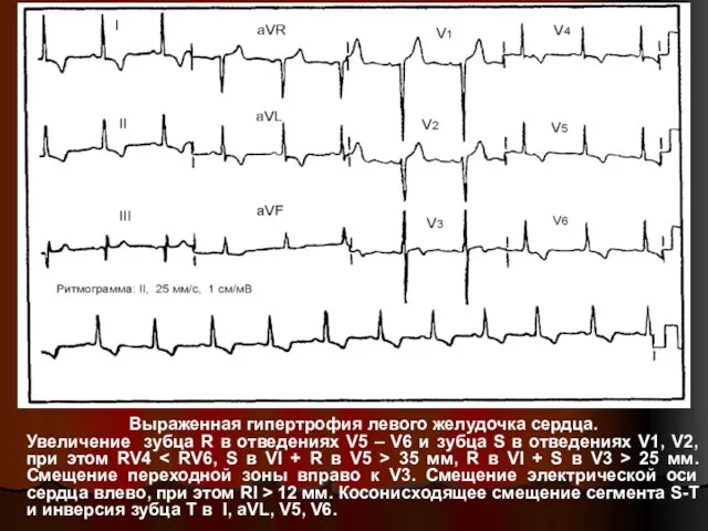 Выраженная гипертрофия левого желудочка сердца. Увеличение зубца R в отведениях V5 –