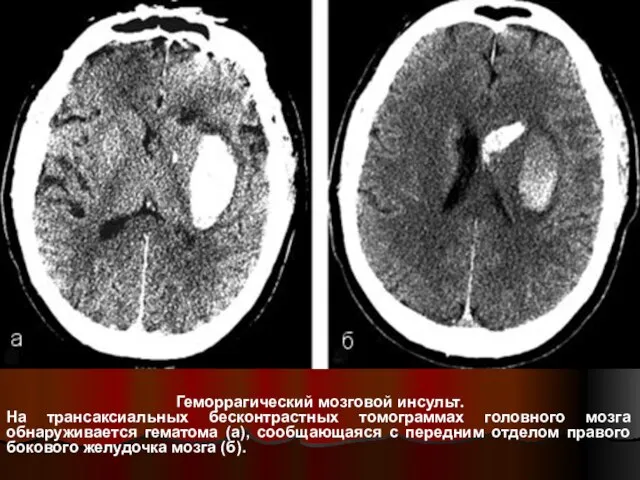 Геморрагический мозговой инсульт. На трансаксиальных бесконтрастных томограммах головного мозга обнаруживается гематома (а),