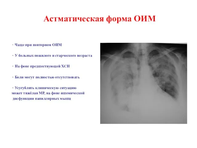 Астматическая форма ОИМ ۰ Чаще при повторном ОИМ ۰ У больных пожилого