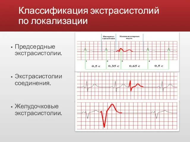 Классификация экстрасистолий по локализации Предсердные экстрасистолии. Экстрасистолии из АВ соединения. Желудочковые экстрасистолии.