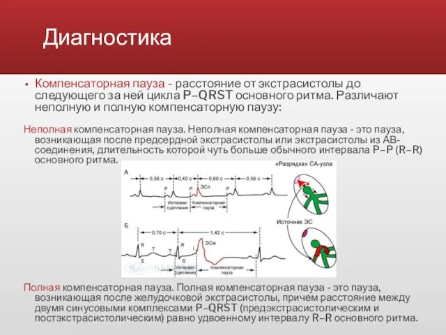 Диагностика Компенсаторная пауза - расстояние от экстрасистолы до следующего за ней цикла