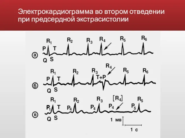 Электрокардиограмма во втором отведении при предсердной экстрасистолии