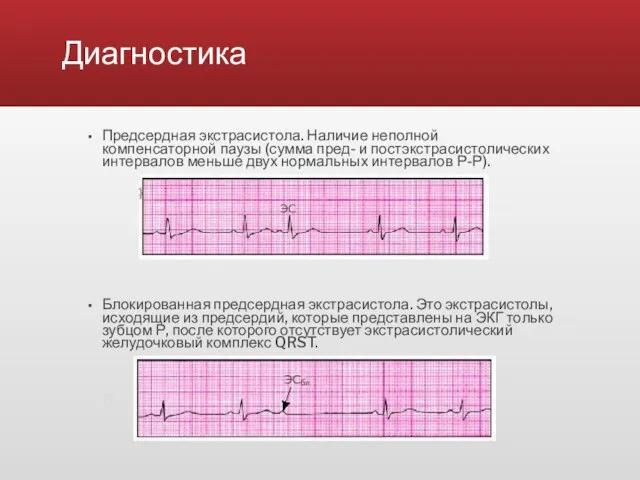 Диагностика Предсердная экстрасистола. Наличие неполной компенсаторной паузы (сумма пред- и постэкстрасистолических интервалов