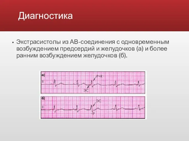 Диагностика Экстрасистолы из АВ-соединения с одновременным возбуждением предсердий и желудочков (а) и