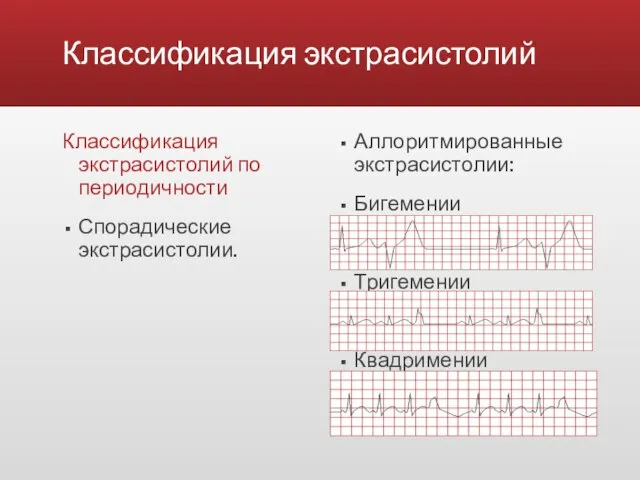 Классификация экстрасистолий Классификация экстрасистолий по периодичности Спорадические экстрасистолии. Аллоритмированные экстрасистолии: Бигемении Тригемении Квадримении