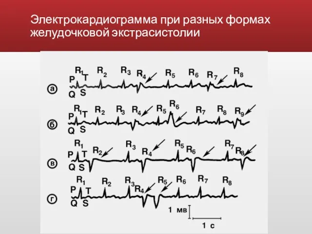 Электрокардиограмма при разных формах желудочковой экстрасистолии