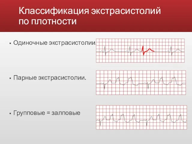 Классификация экстрасистолий по плотности Одиночные экстрасистолии. Парные экстрасистолии. Групповые = залповые