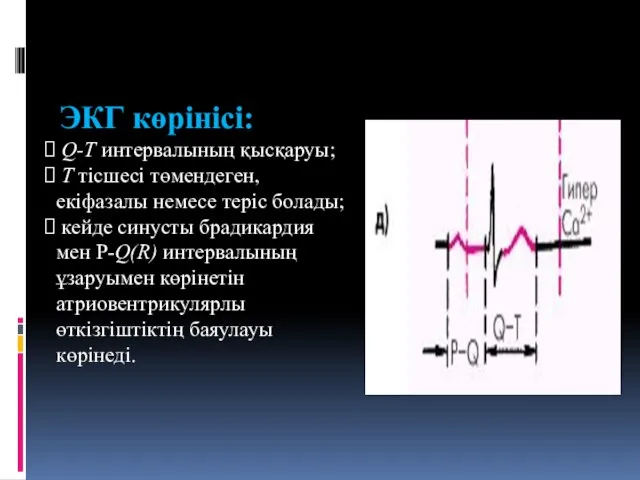 ЭКГ көрінісі: Q-T интервалының қысқаруы; Т тісшесі төмендеген, екіфазалы немесе теріс болады;