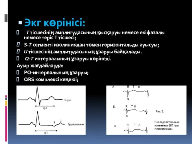 Экг көрінісі: Т тісшесінің амплитудасының қысқаруы немесе екіфазалы немесе теріс Т тісшесі;