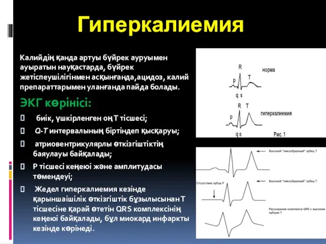 Гиперкалиемия Калийдің қанда артуы бүйрек ауруымен ауыратын науқастарда, бүйрек жетіспеушілігінмен асқынғанда,ацидоз, калий