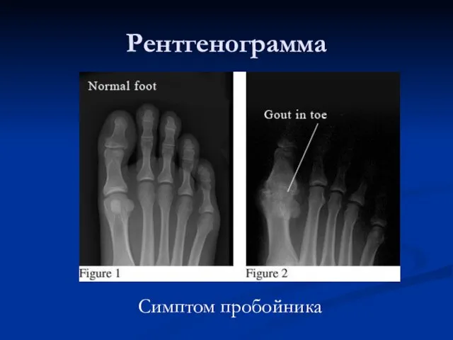 Рентгенограмма Симптом пробойника