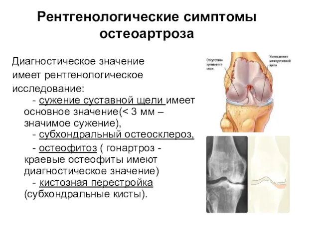 Диагностическое значение имеет рентгенологическое исследование: - сужение суставной щели имеет основное значение(