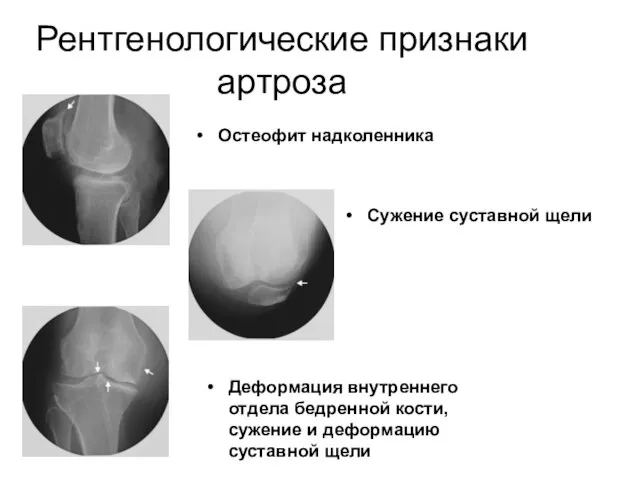 Рентгенологические признаки артроза Остеофит надколенника Сужение суставной щели Деформация внутреннего отдела бедренной