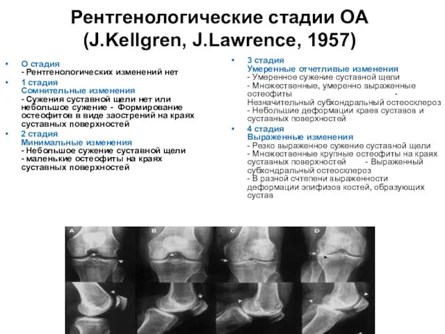 Рентгенологические стадии ОА (J.Kellgren, J.Lawrence, 1957) О стадия - Рентгенологических изменений нет