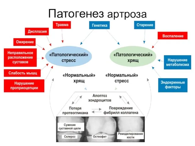 Патогенез артроза