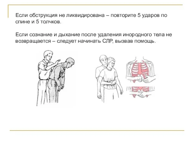 Если обструкция не ликвидирована – повторите 5 ударов по спине и 5