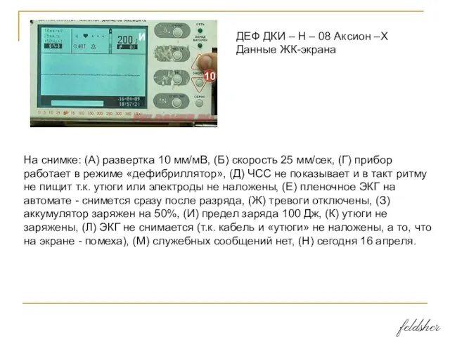 На снимке: (А) развертка 10 мм/мВ, (Б) скорость 25 мм/сек, (Г) прибор