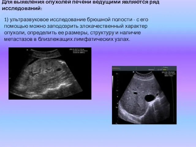 Для выявления опухолей печени ведущими являются ряд исследований: 1) ультразвуковое исследование брюшной