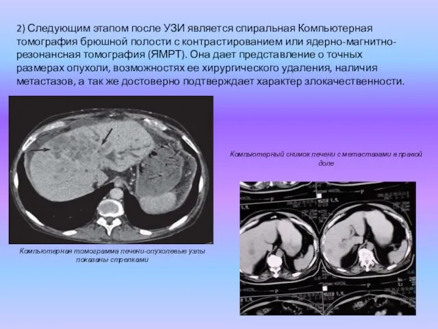 2) Следующим этапом после УЗИ является спиральная Компьютерная томография брюшной полости с