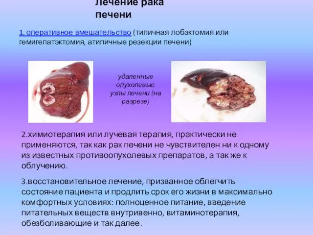 Лечение рака печени 1. оперативное вмешательство (типичная лобэктомия или гемигепатэктомия, атипичные резекции