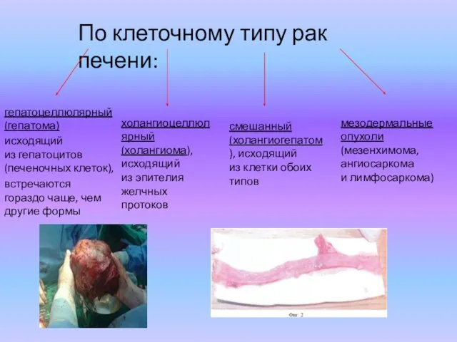 По клеточному типу рак печени: гепатоцеллюлярный (гепатома) исходящий из гепатоцитов (печеночных клеток),