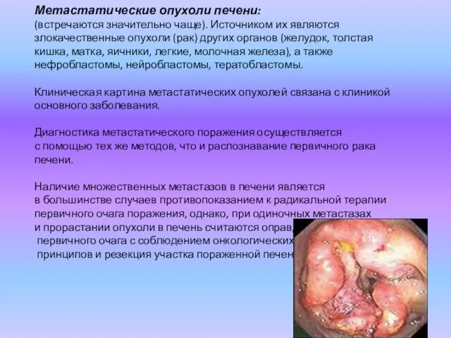 Метастатические опухоли печени: (встречаются значительно чаще). Источником их являются злокачественные опухоли (рак)