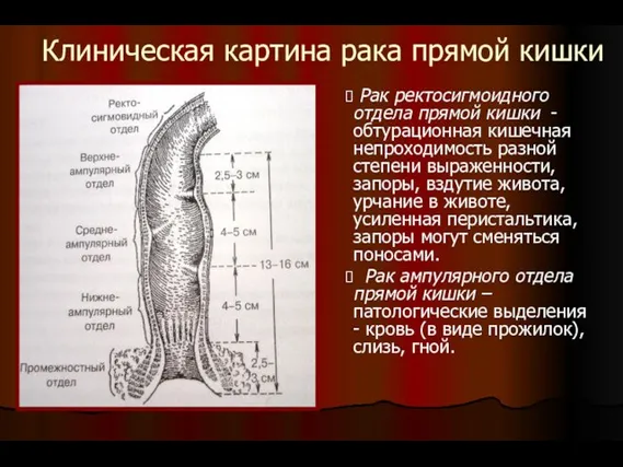 Клиническая картина рака прямой кишки Рак ректосигмоидного отдела прямой кишки - обтурационная