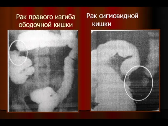 Рак правого изгиба ободочной кишки Рак сигмовидной кишки