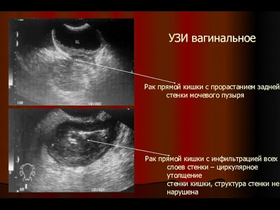 УЗИ вагинальное Рак прямой кишки с инфильтрацией всех слоев стенки – циркулярное