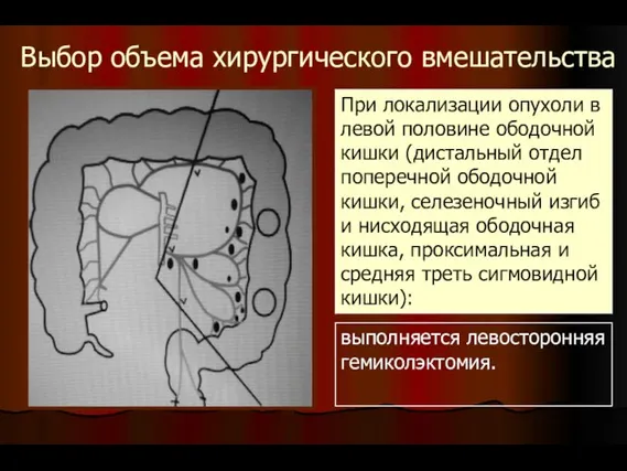 Выбор объема хирургического вмешательства