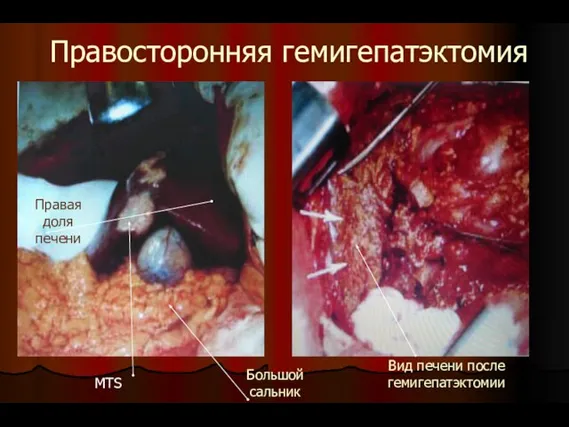 Правосторонняя гемигепатэктомия Правая доля печени MTS Большой сальник Вид печени после гемигепатэктомии