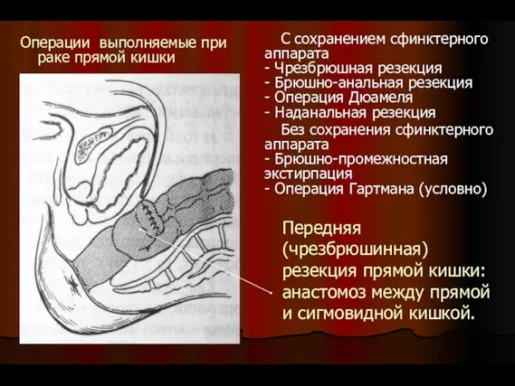 Передняя (чрезбрюшинная) резекция прямой кишки: анастомоз между прямой и сигмовидной кишкой. С