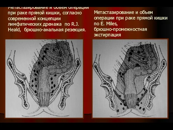 Метастазирование и объем операции при раке прямой кишки, согласно современной концепции лимфатических