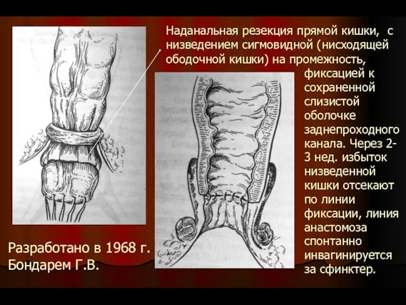 Наданальная резекция прямой кишки, с низведением сигмовидной (нисходящей ободочной кишки) на промежность,