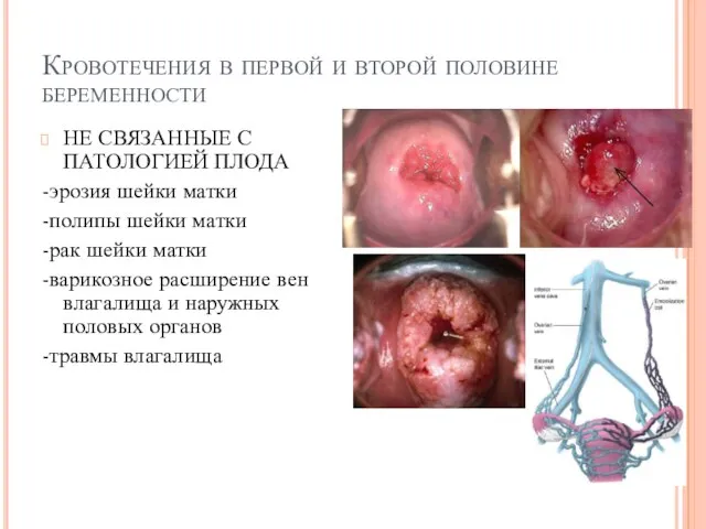 Кровотечения в первой и второй половине беременности НЕ СВЯЗАННЫЕ С ПАТОЛОГИЕЙ ПЛОДА