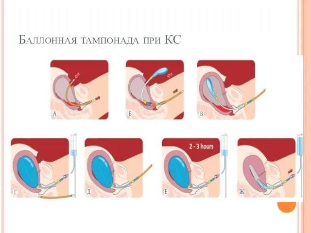 Баллонная тампонада при КС