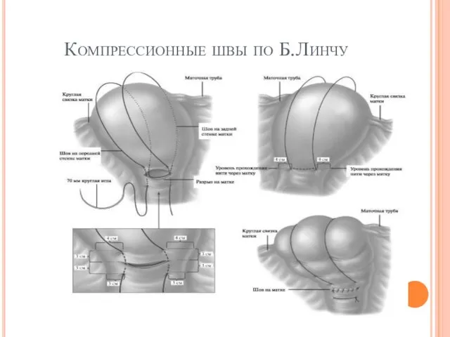 Компрессионные швы по Б.Линчу