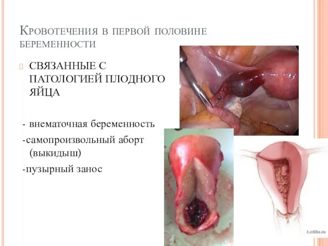 Кровотечения в первой половине беременности СВЯЗАННЫЕ С ПАТОЛОГИЕЙ ПЛОДНОГО ЯЙЦА - внематочная