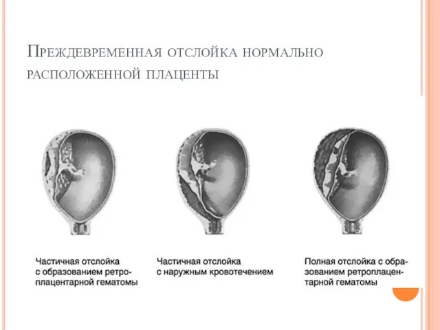 Преждевременная отслойка нормально расположенной плаценты