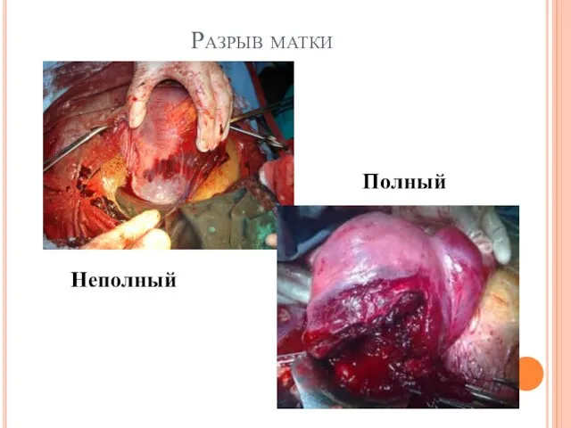 Разрыв матки Неполный Полный