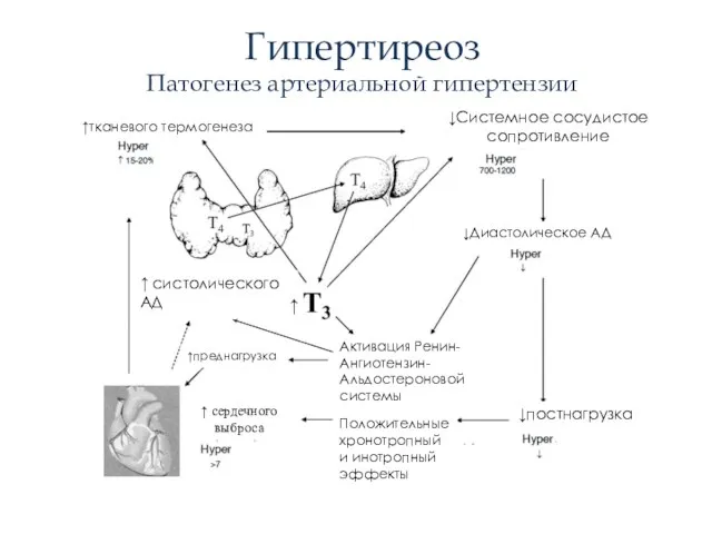 Гипертиреоз Патогенез артериальной гипертензии ↓Системное сосудистое сопротивление ↓Диастолическое АД ↓постнагрузка Активация Ренин-Ангиотензин-Альдостероновой