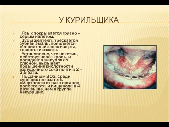 У КУРИЛЬЩИКА Язык покрывается грязно – серым налётом. Зубы желтеют, трескается зубная