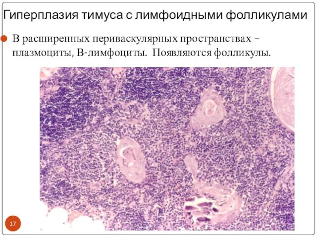 Гиперплазия тимуса с лимфоидными фолликулами В расширенных периваскулярных пространствах – плазмоциты, В-лимфоциты. Появляются фолликулы.