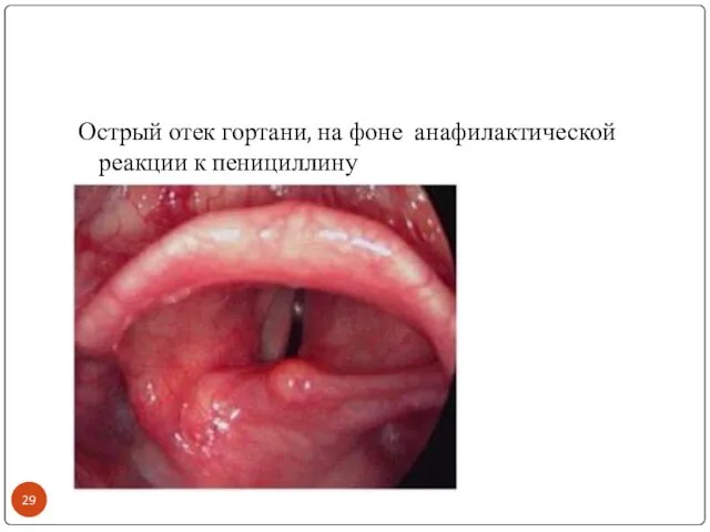 Острый отек гортани, на фоне анафилактической реакции к пенициллину