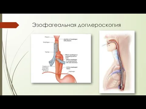 Эзофагеальная доплероскопия