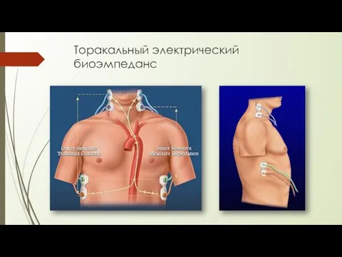 Торакальный электрический биоэмпеданс