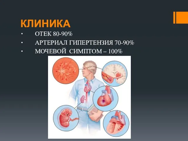 КЛИНИКА ∙ ОТЕК 80-90% ∙ АРТЕРИАЛ ГИПЕРТЕНЗИЯ 70-90% ∙ МОЧЕВОЙ СИМПТОМ – 100%