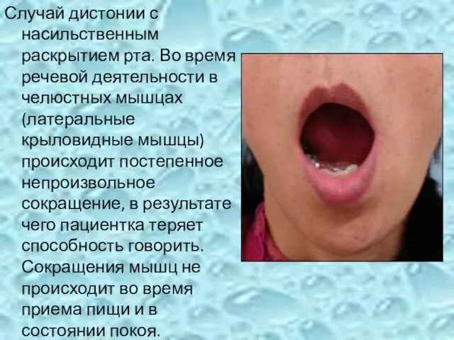 Случай дистонии с насильственным раскрытием рта. Во время речевой деятельности в челюстных